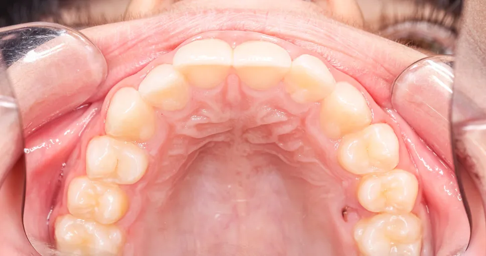 Teeth magnification 2